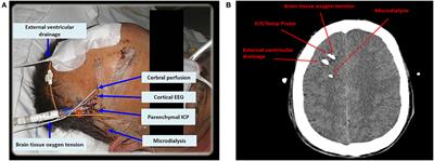 Clinical Use of Cerebral Microdialysis in Patients with Aneurysmal Subarachnoid Hemorrhage—State of the Art